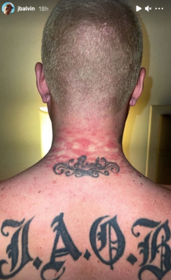 j Balvin se lastima el cuello por usar su cadena 
